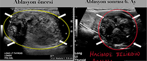 Tiroid Nodül Ablasyonu: Minimal İnvaziv Tedavi Yöntemi
